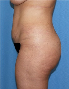 Tummy Tuck Before Photo by Siamak Agha, MD PhD FACS; Newport Beach, CA - Case 46766