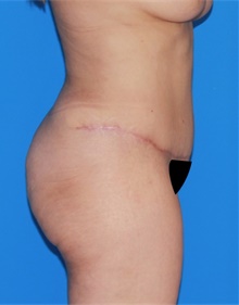 Tummy Tuck After Photo by Siamak Agha, MD PhD FACS; Newport Beach, CA - Case 46766
