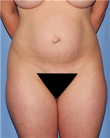 Tummy Tuck Before Photo by Siamak Agha, MD PhD FACS; Newport Beach, CA - Case 46767