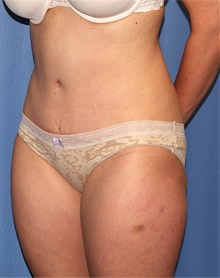 Tummy Tuck After Photo by Siamak Agha, MD PhD FACS; Newport Beach, CA - Case 46767