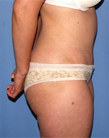 Tummy Tuck After Photo by Siamak Agha, MD PhD FACS; Newport Beach, CA - Case 46767