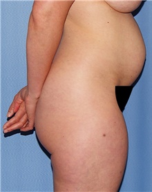 Tummy Tuck Before Photo by Siamak Agha, MD PhD FACS; Newport Beach, CA - Case 46767