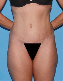 Tummy Tuck After Photo by Siamak Agha, MD PhD FACS; Newport Beach, CA - Case 46768