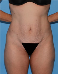 Tummy Tuck Before Photo by Siamak Agha, MD PhD FACS; Newport Beach, CA - Case 46768