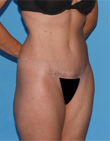 Tummy Tuck After Photo by Siamak Agha, MD PhD FACS; Newport Beach, CA - Case 46768
