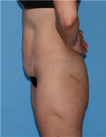 Tummy Tuck Before Photo by Siamak Agha, MD PhD FACS; Newport Beach, CA - Case 46768