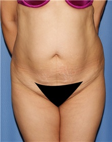 Tummy Tuck Before Photo by Siamak Agha, MD PhD FACS; Newport Beach, CA - Case 46769