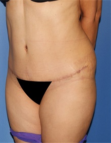 Tummy Tuck After Photo by Siamak Agha, MD PhD FACS; Newport Beach, CA - Case 46769