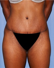 Tummy Tuck After Photo by Siamak Agha, MD; Newport Beach, CA - Case 46770