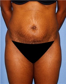 Tummy Tuck Before Photo by Siamak Agha, MD; Newport Beach, CA - Case 46770