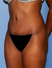 Tummy Tuck After Photo by Siamak Agha, MD PhD FACS; Newport Beach, CA - Case 46770