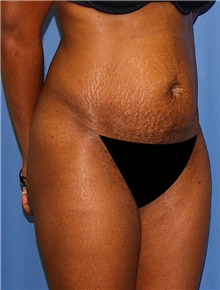 Tummy Tuck Before Photo by Siamak Agha, MD PhD FACS; Newport Beach, CA - Case 46770
