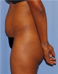 Tummy Tuck Before Photo by Siamak Agha, MD PhD FACS; Newport Beach, CA - Case 46770