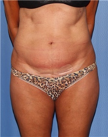 Tummy Tuck Before Photo by Siamak Agha, MD PhD FACS; Newport Beach, CA - Case 46772
