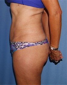 Tummy Tuck After Photo by Siamak Agha, MD PhD FACS; Newport Beach, CA - Case 46772