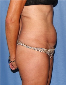 Tummy Tuck Before Photo by Siamak Agha, MD PhD FACS; Newport Beach, CA - Case 46772