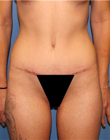 Tummy Tuck After Photo by Siamak Agha, MD PhD FACS; Newport Beach, CA - Case 46773