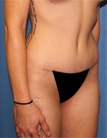 Tummy Tuck After Photo by Siamak Agha, MD PhD FACS; Newport Beach, CA - Case 46773