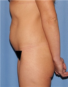Tummy Tuck Before Photo by Siamak Agha, MD PhD FACS; Newport Beach, CA - Case 46773