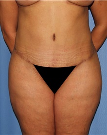 Tummy Tuck After Photo by Siamak Agha, MD PhD FACS; Newport Beach, CA - Case 46774