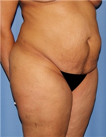 Tummy Tuck Before Photo by Siamak Agha, MD PhD FACS; Newport Beach, CA - Case 46774