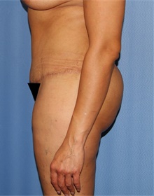 Tummy Tuck After Photo by Siamak Agha, MD PhD FACS; Newport Beach, CA - Case 46774
