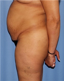 Tummy Tuck Before Photo by Siamak Agha, MD PhD FACS; Newport Beach, CA - Case 46774
