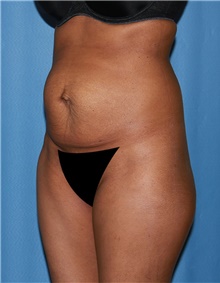 Tummy Tuck Before Photo by Siamak Agha, MD PhD FACS; Newport Beach, CA - Case 46775