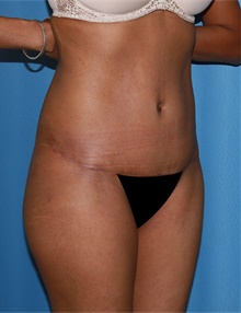 Tummy Tuck After Photo by Siamak Agha, MD PhD FACS; Newport Beach, CA - Case 46775