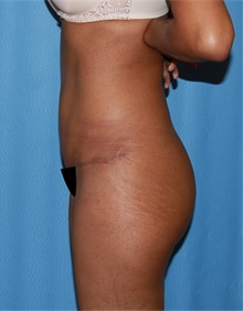 Tummy Tuck After Photo by Siamak Agha, MD PhD FACS; Newport Beach, CA - Case 46775