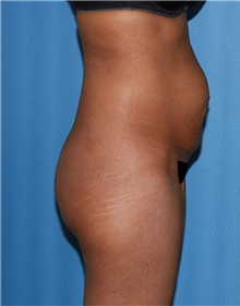 Tummy Tuck Before Photo by Siamak Agha, MD PhD FACS; Newport Beach, CA - Case 46775
