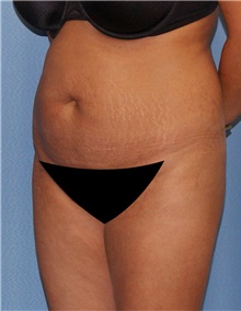 Tummy Tuck Before Photo by Siamak Agha, MD PhD FACS; Newport Beach, CA - Case 46776