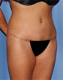 Tummy Tuck After Photo by Siamak Agha, MD PhD FACS; Newport Beach, CA - Case 46776