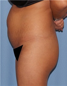 Tummy Tuck Before Photo by Siamak Agha, MD PhD FACS; Newport Beach, CA - Case 46776
