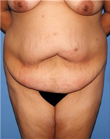 Tummy Tuck Before Photo by Siamak Agha, MD PhD FACS; Newport Beach, CA - Case 46777