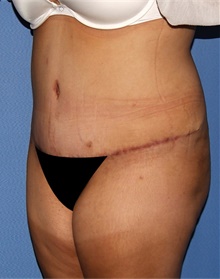 Tummy Tuck After Photo by Siamak Agha, MD PhD FACS; Newport Beach, CA - Case 46777