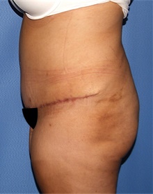 Tummy Tuck After Photo by Siamak Agha, MD PhD FACS; Newport Beach, CA - Case 46777
