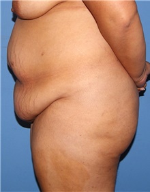 Tummy Tuck Before Photo by Siamak Agha, MD PhD FACS; Newport Beach, CA - Case 46777