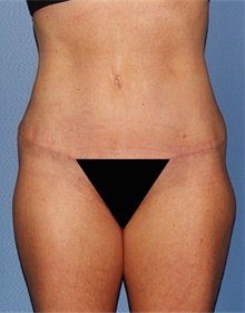 Tummy Tuck After Photo by Siamak Agha, MD; Newport Beach, CA - Case 46778