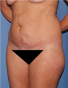 Tummy Tuck Before Photo by Siamak Agha, MD PhD FACS; Newport Beach, CA - Case 46778