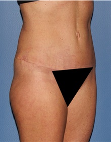 Tummy Tuck After Photo by Siamak Agha, MD PhD FACS; Newport Beach, CA - Case 46778