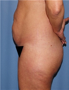 Tummy Tuck Before Photo by Siamak Agha, MD PhD FACS; Newport Beach, CA - Case 46778