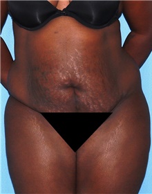 Tummy Tuck Before Photo by Siamak Agha, MD PhD FACS; Newport Beach, CA - Case 46779