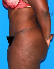 Tummy Tuck After Photo by Siamak Agha, MD PhD FACS; Newport Beach, CA - Case 46779