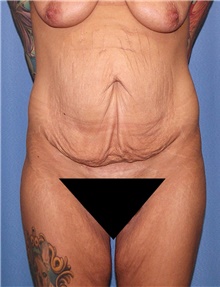 Tummy Tuck Before Photo by Siamak Agha, MD PhD FACS; Newport Beach, CA - Case 46780