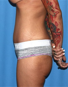 Tummy Tuck After Photo by Siamak Agha, MD PhD FACS; Newport Beach, CA - Case 46780