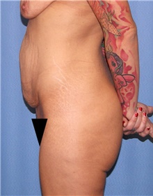 Tummy Tuck Before Photo by Siamak Agha, MD PhD FACS; Newport Beach, CA - Case 46780