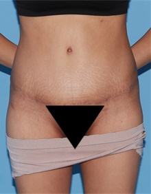 Tummy Tuck After Photo by Siamak Agha, MD PhD FACS; Newport Beach, CA - Case 46781