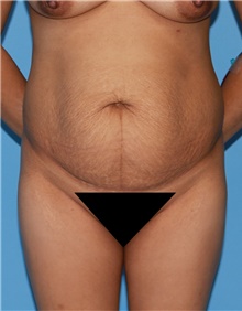 Tummy Tuck Before Photo by Siamak Agha, MD PhD FACS; Newport Beach, CA - Case 46781