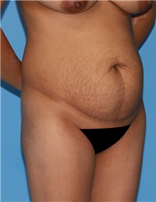 Tummy Tuck Before Photo by Siamak Agha, MD PhD FACS; Newport Beach, CA - Case 46781